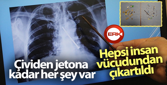 Hepsi insan vücudundan çıkartıldı, çividen jetona kadar her şey var