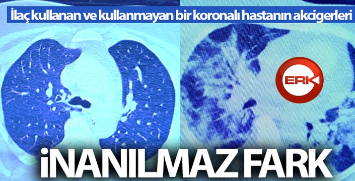 İlaç kullanan korona hastaları ile kullanmayanlar arasındaki inanılmaz fark