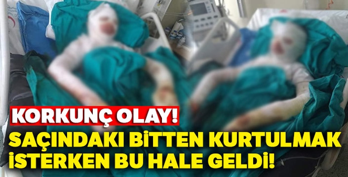 Liseli kız bitlenen saçlarını benzinle yıkamak isterken kendini yaktı