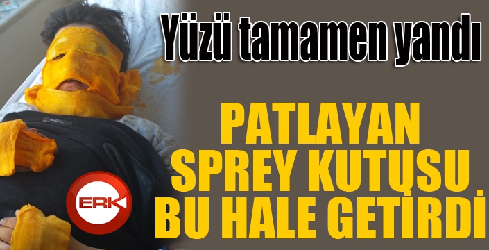 Sprey kutusu patladı, küçük çocuğun yüzü feci şekilde yandı