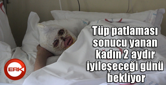 Tüp patlaması sonucu yanan kadın 2 aydır iyileşeceği günü bekliyor